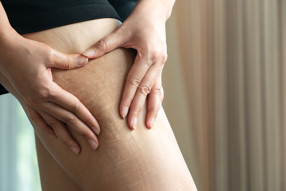 Banishing Stretch Marks: Expert Tips for Smoother, Healthier Skin